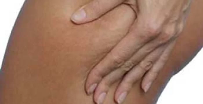 Cellulite - Cure e rimedi per la cellulite